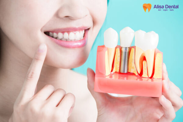 cấy ghép implant