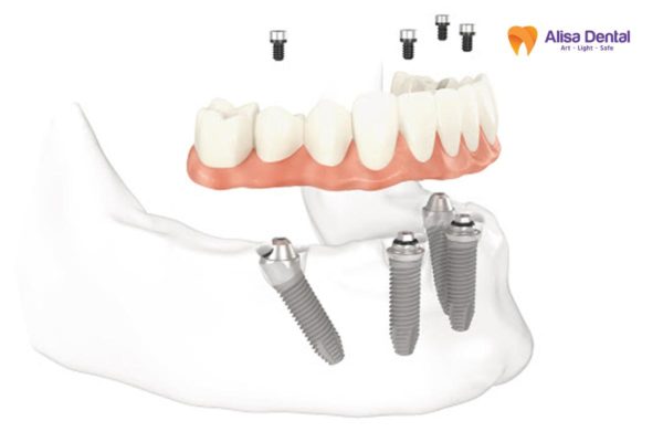 trồng răng implant hà nội Alisa