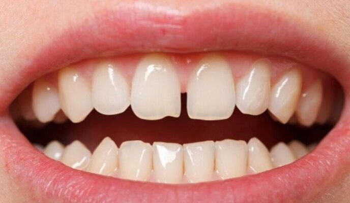 xử lí khi bị rơi răng sứ