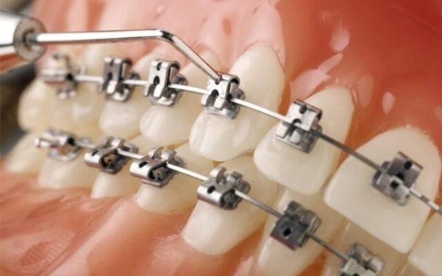 Phương pháp niềng răng tự buộc (Self-Ligating Braces)