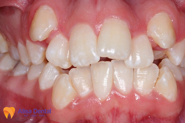Trường hợp niềng răng khi răng chen chúc
