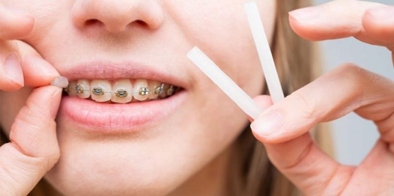 sáp nha khoa-mẹo chăm sóc răng niềng