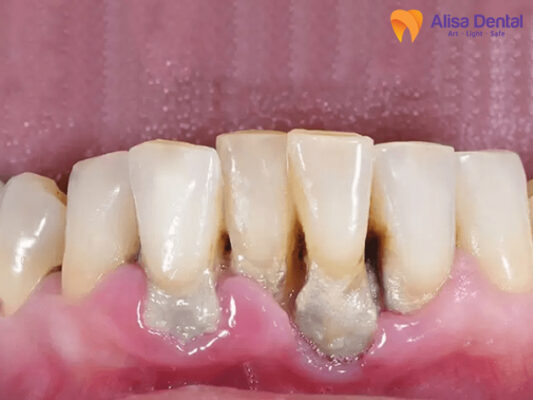 TH cần cấy ghép implant gấp