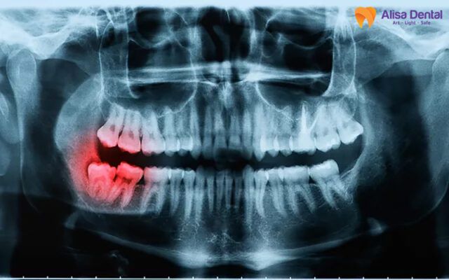 x quang chuẩn bị cấy ghép implant