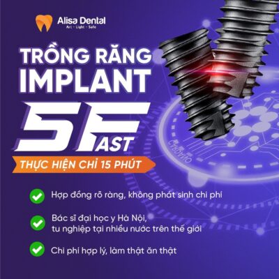 trồng răng implant 5 fast