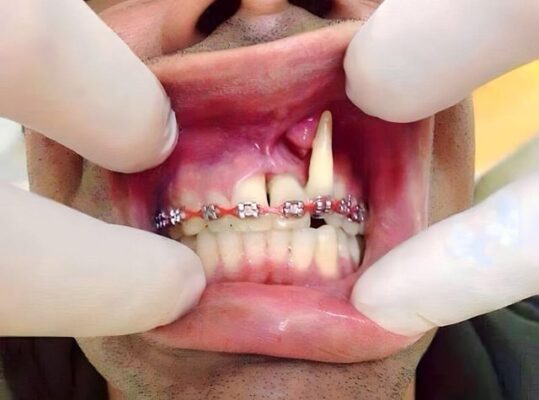 tiêu xương răng do niềng răng