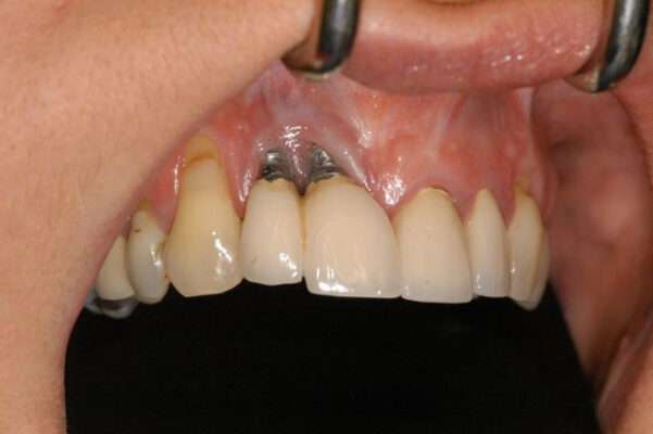 đào thải trụ Implant