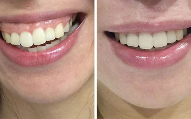 cắt lợi chữa cười hở loiej