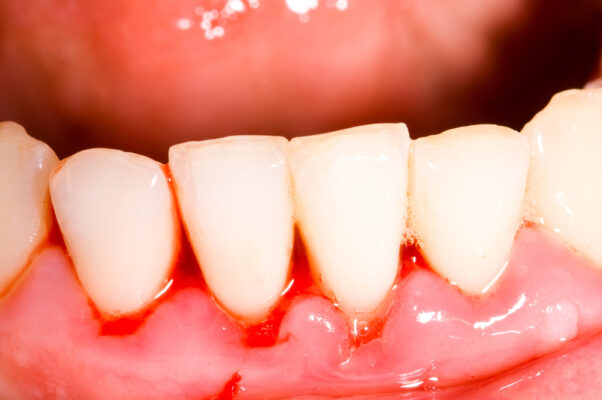 Vấn đề "chảy máu kéo dài" sau trồng răng implant