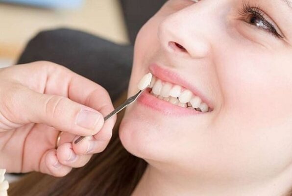 răng khểnh bọc sứ có được không?