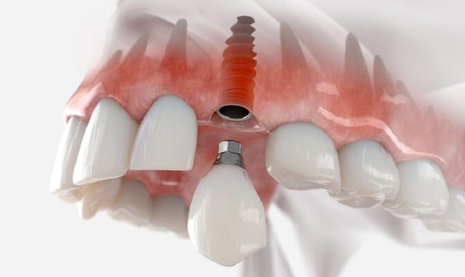 trồng răng Implant tức thì là gì