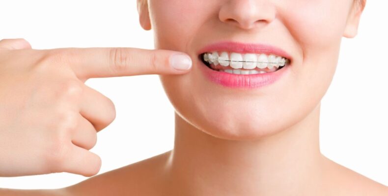 niềng rnawg mắc cài sứ