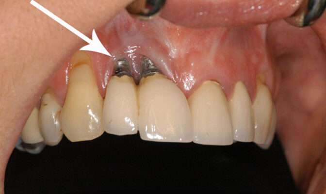 trồng răng implant giá rẻ chất lượng không đảm bảo