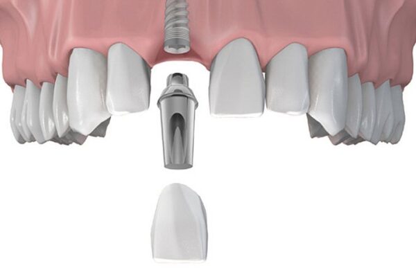 trồng răng Implant tức thì là gì