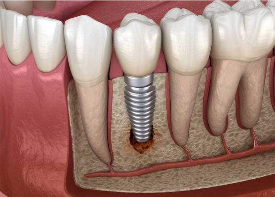 đào thải trụ Implant