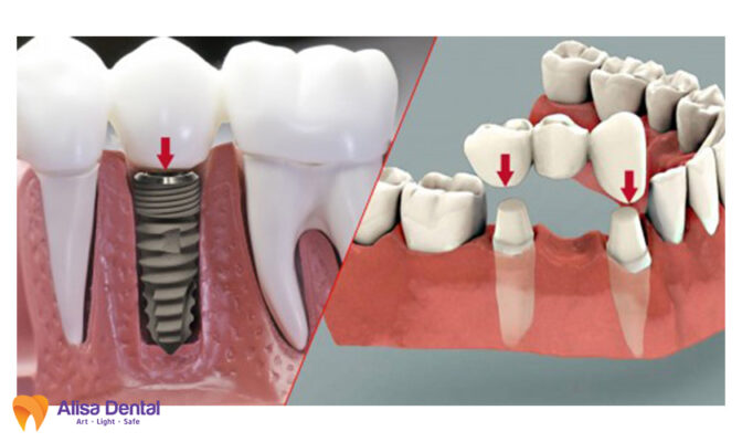 chọn trồng răng Implant hay trồng răng sứ bắc cầu?