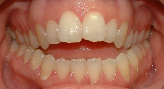 sai lệch khớp cắn hở