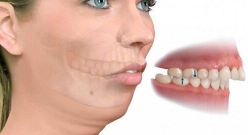 sai lệch khớp cắn sâu