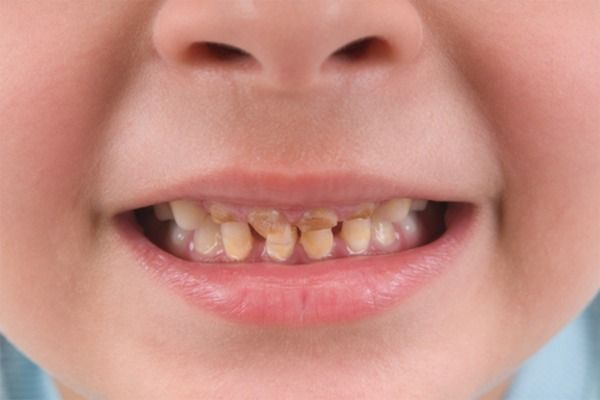 răng ố vàng di truyền 