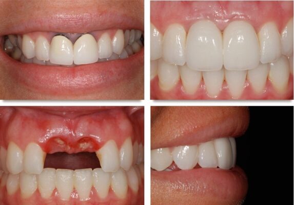 Implant không tích hợp với xương hàm