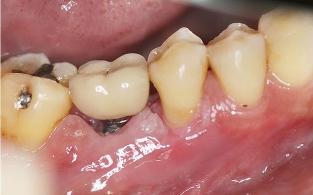 trồng răng Implant sai cách gây biến dạng