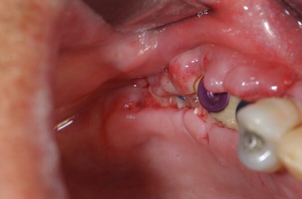 trồng răng Implant sai cách gây nhiễm trùng