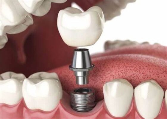 trồng răng Implant tức thì là gì