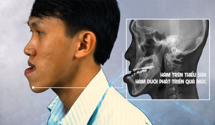 sai lệch khớp cắn ngược