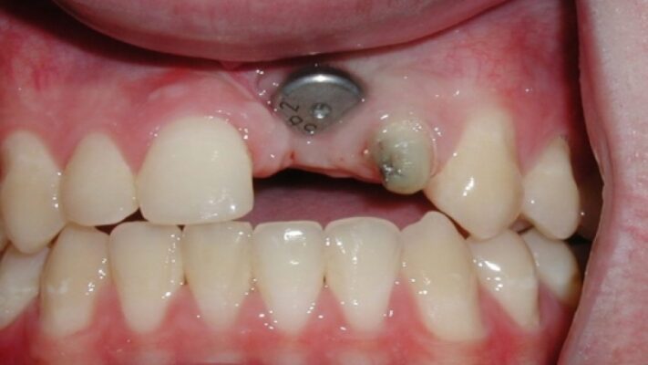 trồng răng Implant sai cách không tích hơp với xuongs hàm