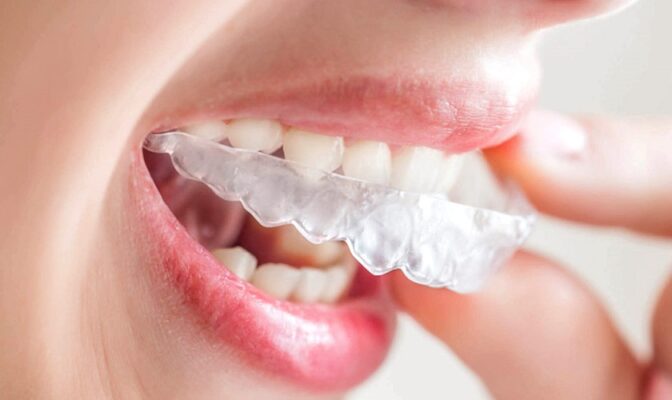 niềng răng Invisalign ưu điểm