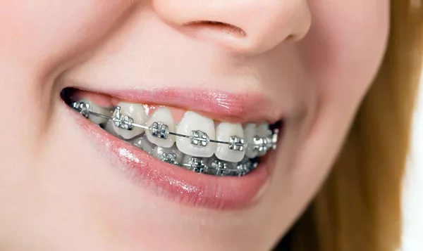 sai lệch khớp cắn khắc phục như thế nào
