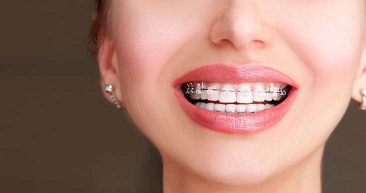niềng răng mắc cài sứ