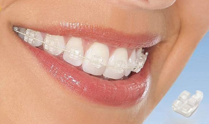 Niềng răng mắc cài sứ