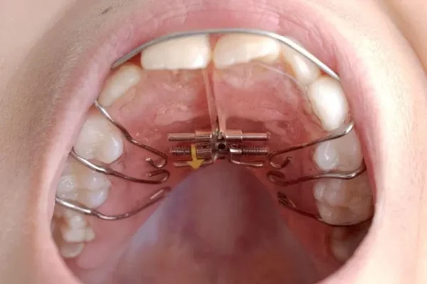 sai lệch khớp cắn ảnh hưởng như thế nào