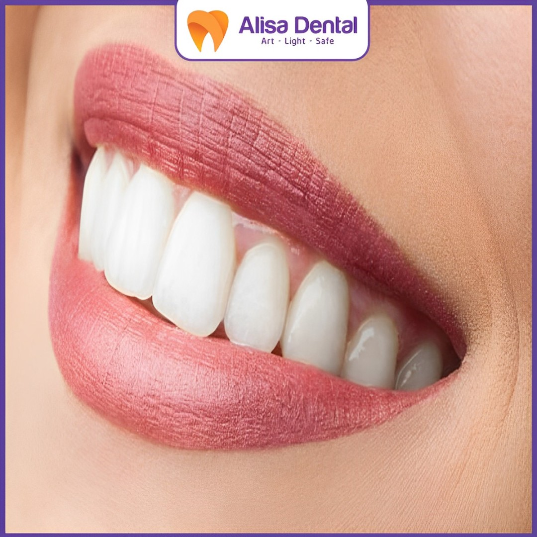 dáng răng sứ hot trend oval