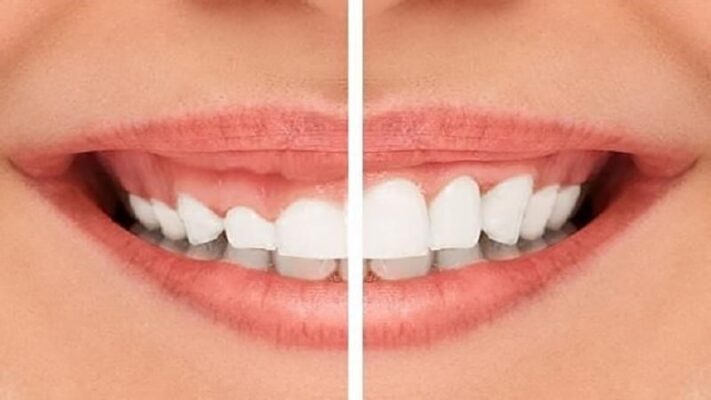 cắt lợi chữa cười hở lợi