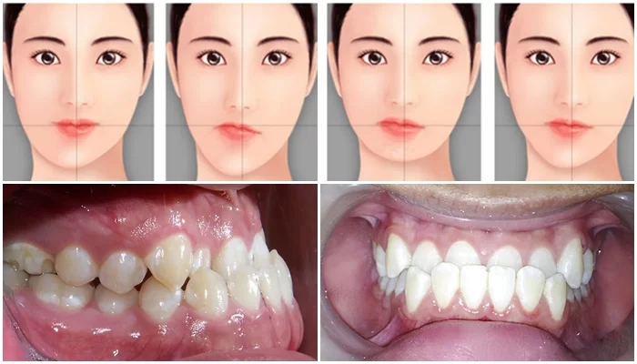 sai lệch khớp cắn ảnh hưởng như thế nào