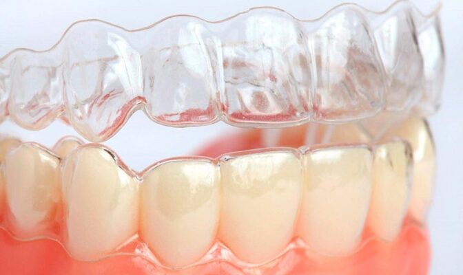 niêng răng Invisalign hoạt động ra sao