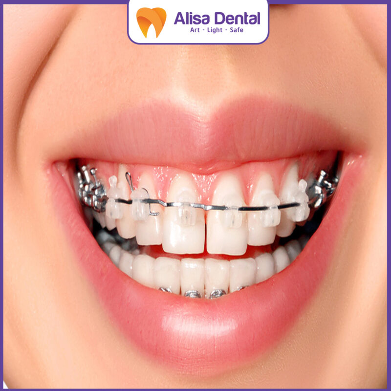 hypodontia