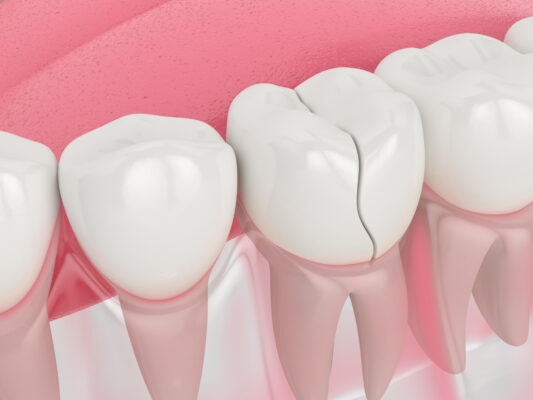 trồng răng Implant sai cách gây gãy nứt Implant