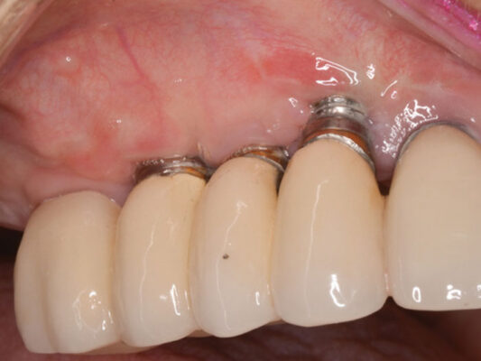 đào thải trụ Implant