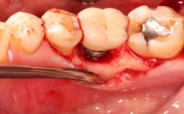 trồng răng Implant bị viêm quanh trụ