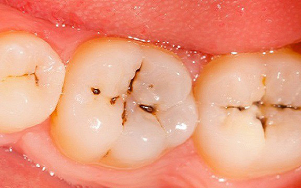 Dấu hiệu nhận biết sâu răng