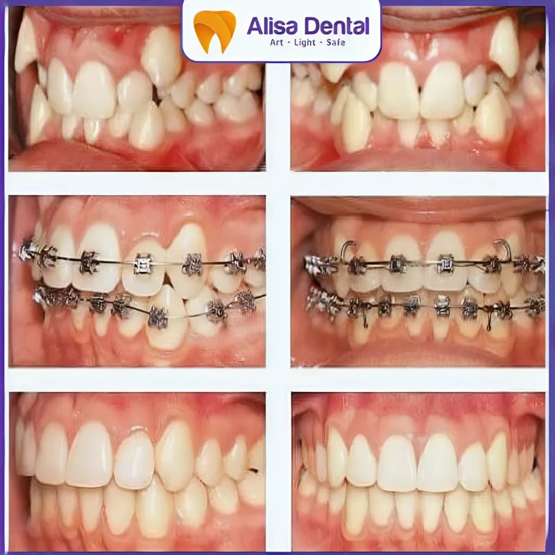 răng chạy lại sau khi niềng