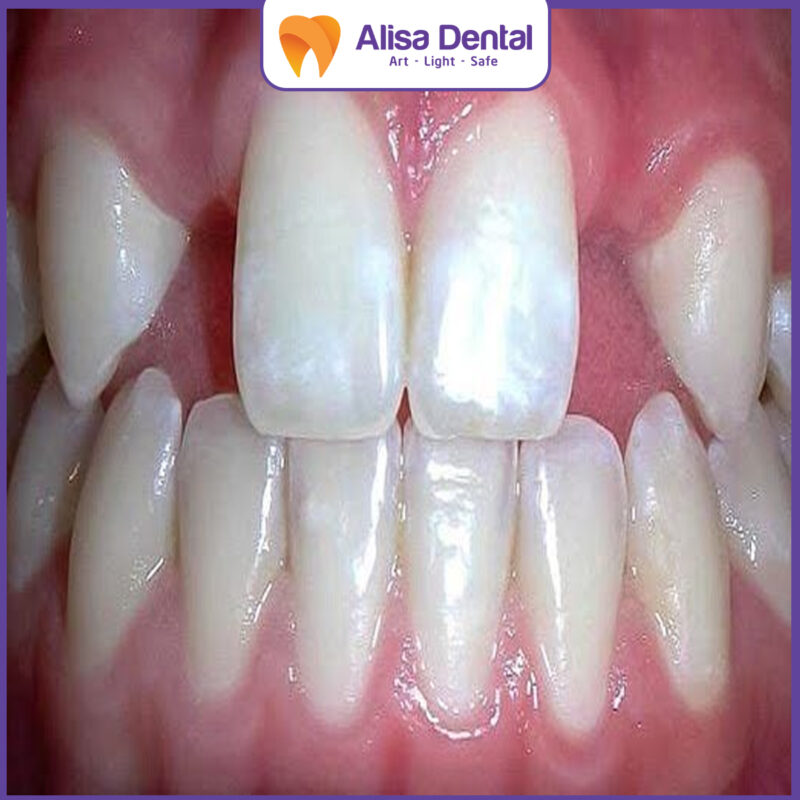 hypodontia