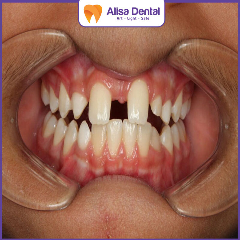 hypodontia