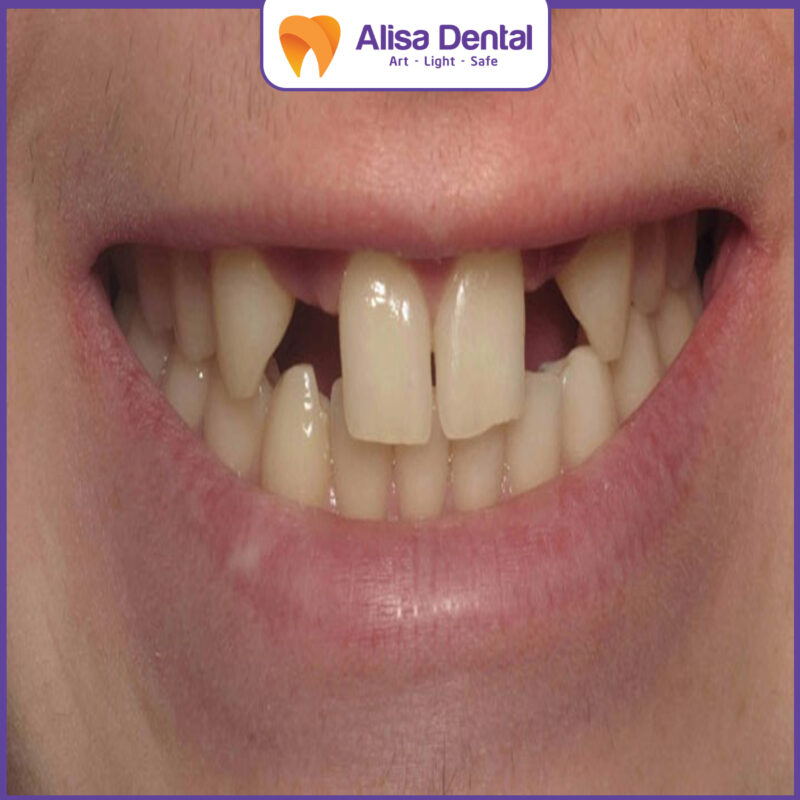 hypodontia