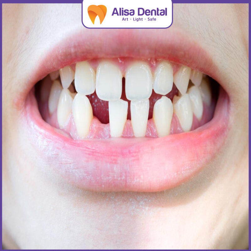 hypodontia