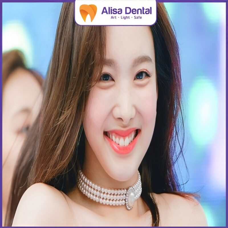 dáng răng sứ hot trend thỏ