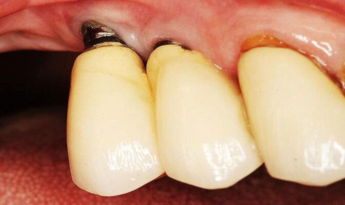 trồng răng Implant sai cách gây tổn thương răng xung quanh